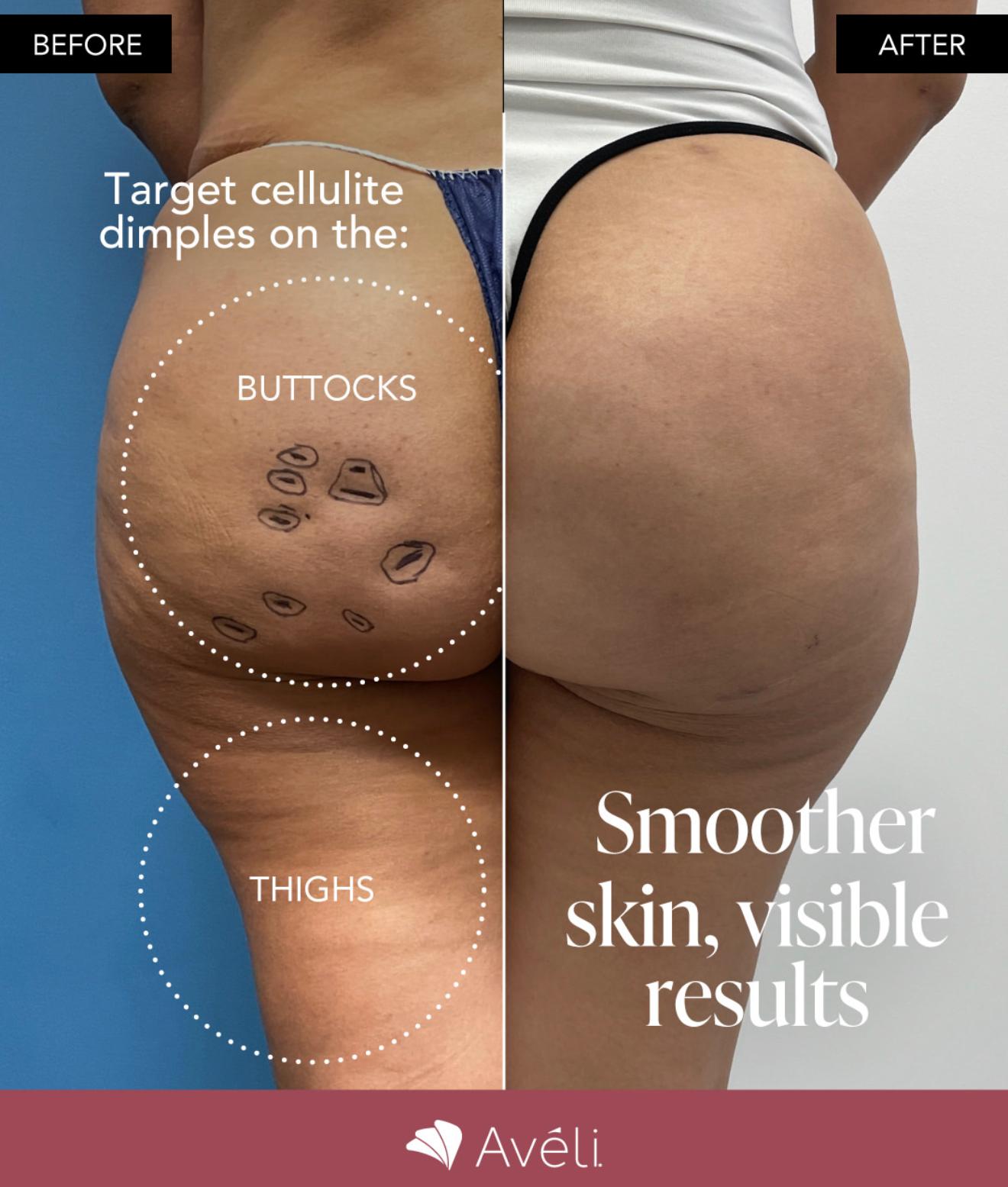 Aveli Cellulite Treatment