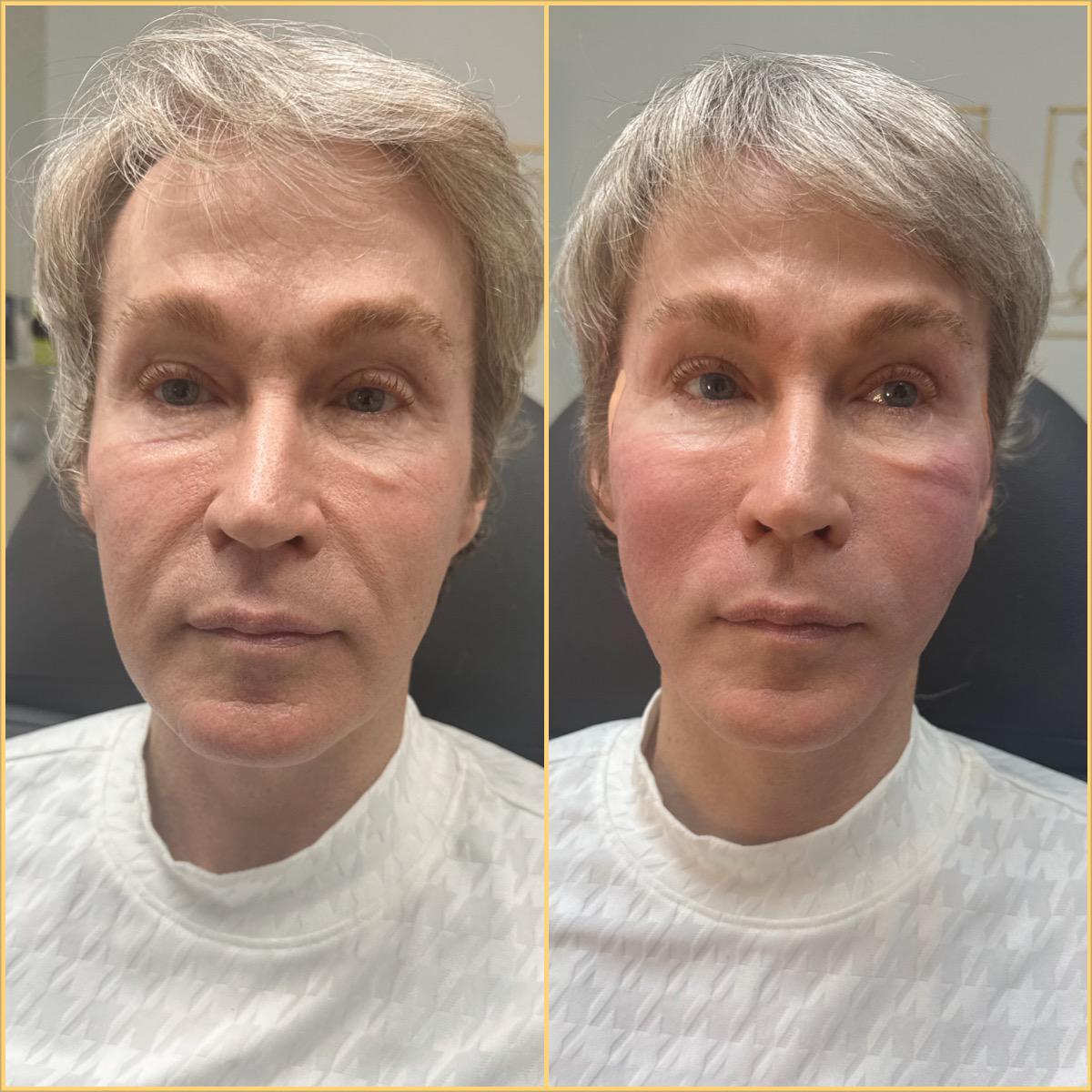 PDO Threads Facelift