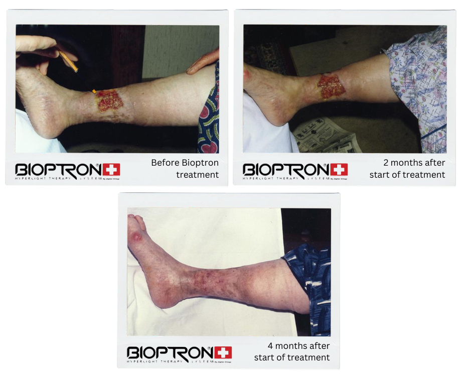 Leg wound healing progress before and after Bioptron treatment