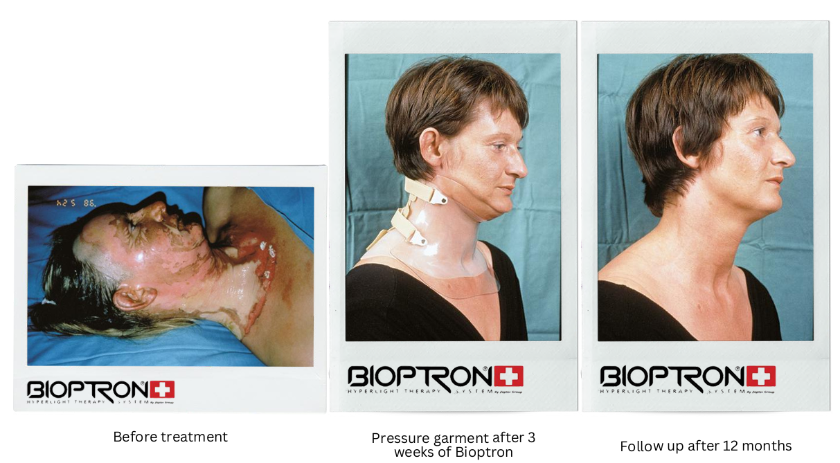 Neck and face burn healing progress