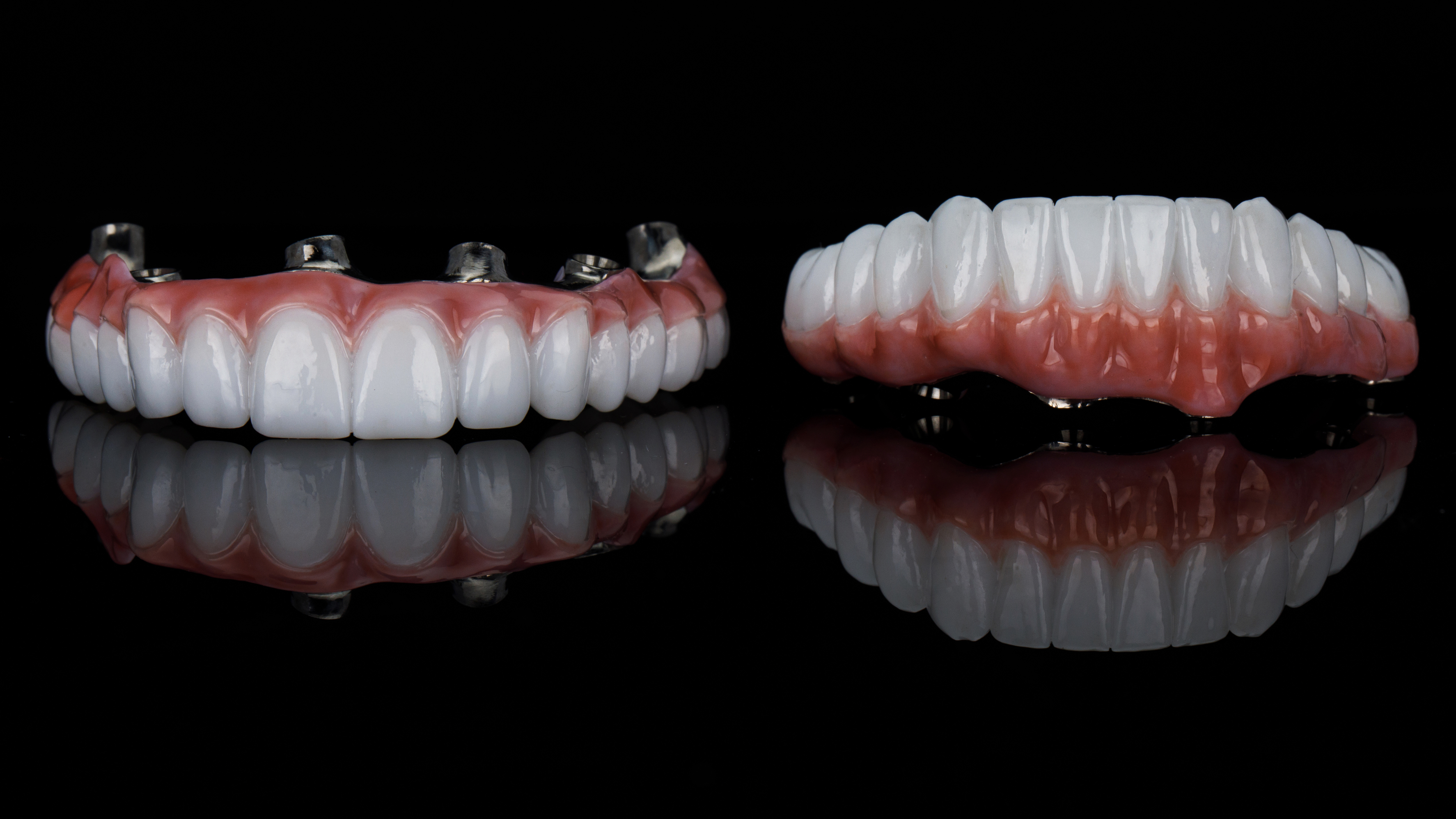 Full Arch Dental Implant Model