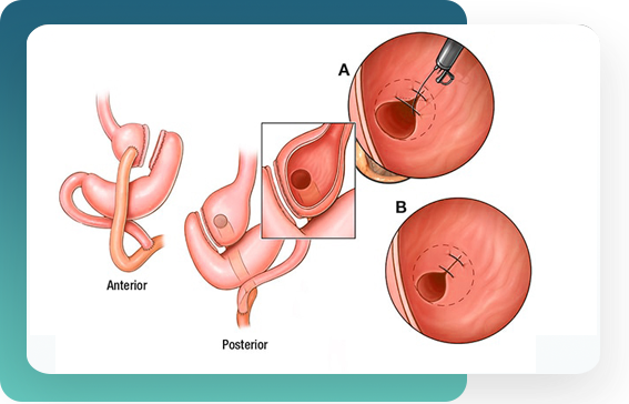 Cirugía de Revisión Bariátrica