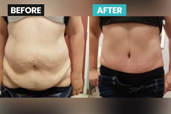 Panniculectomía y Abdominoplastia