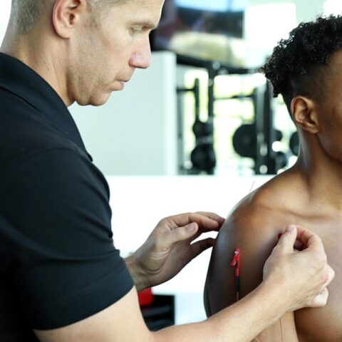 SoFloPT Dry Needling Detail 2