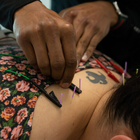 SoFloPT Dry Needling Detail 3
