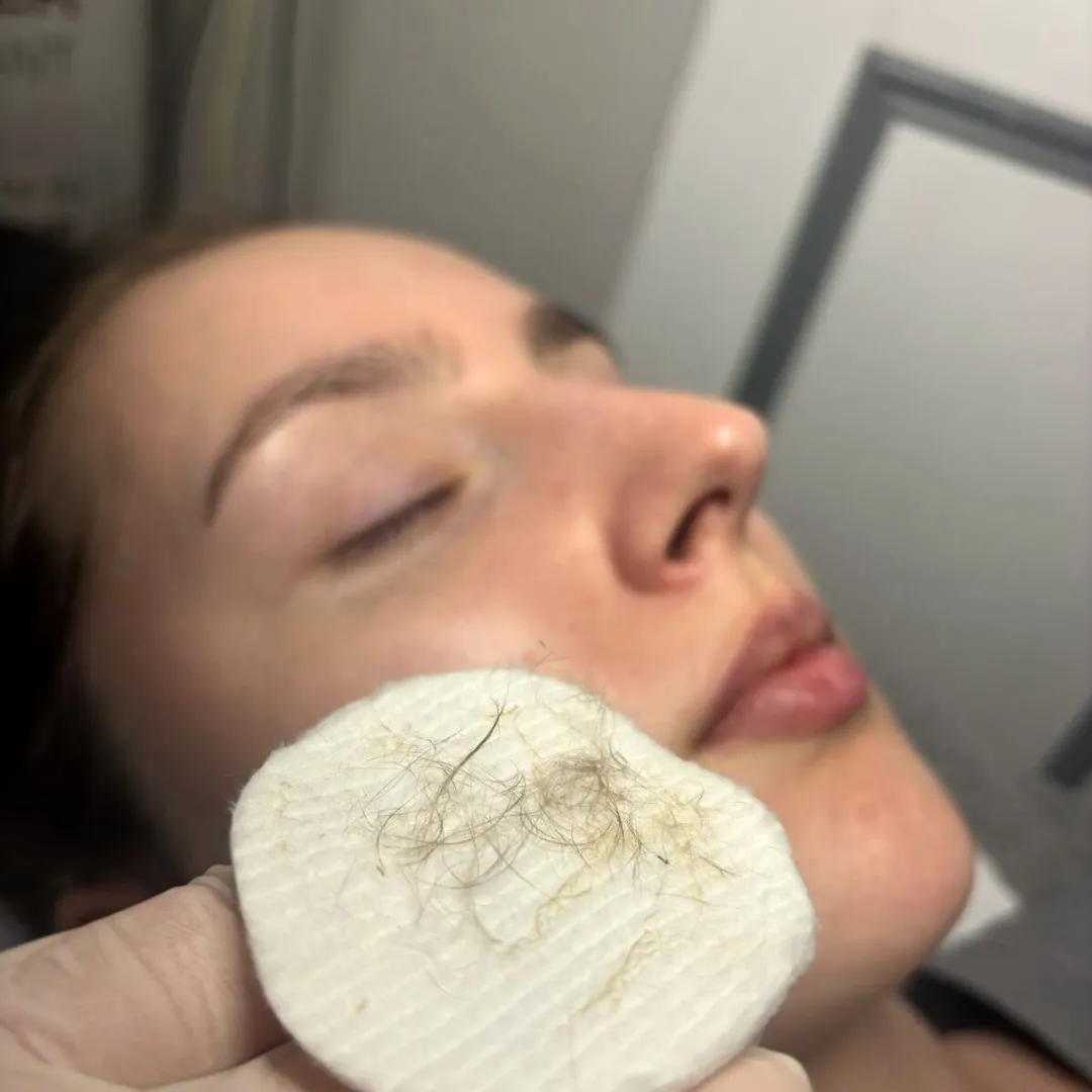 Client face after dermaplaning treatment