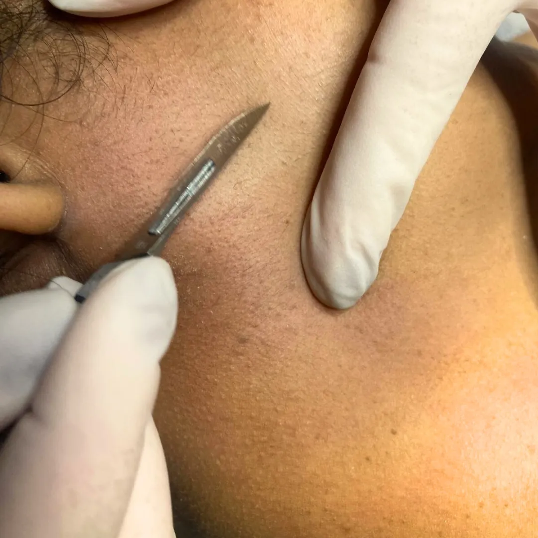 Dermaplaning treatment on cheek