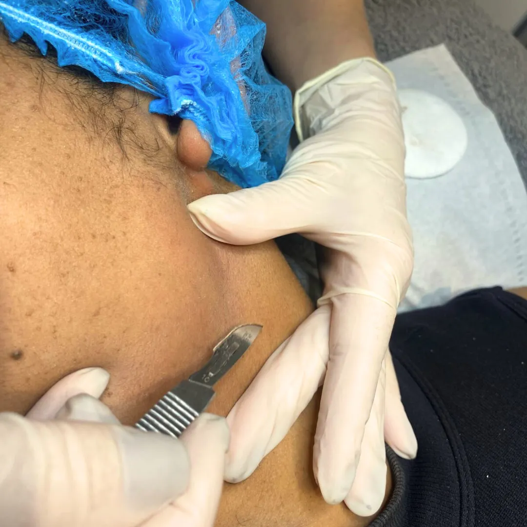 Dermaplaning treatment on neck