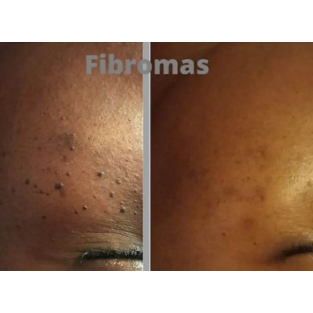 Fibromas treatment results