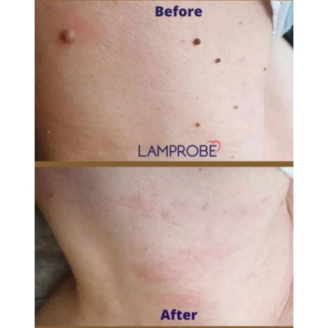 Before and after treatment