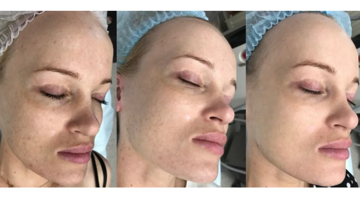 BioRePeel Results