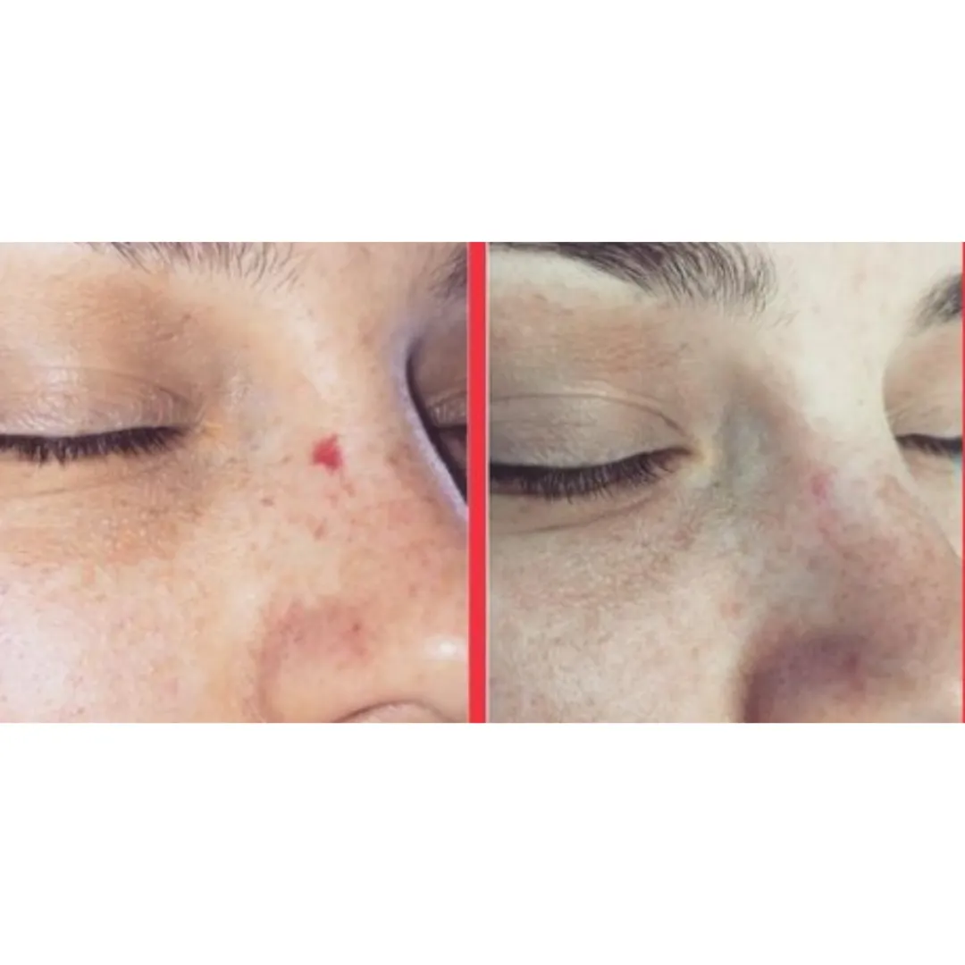 Facial skin irregularities treatment