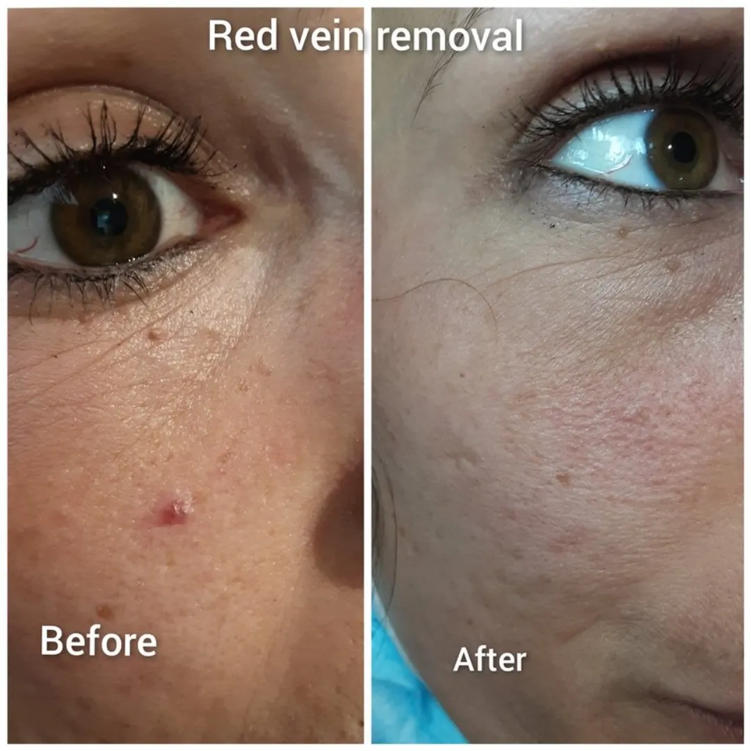 Red vein removal results