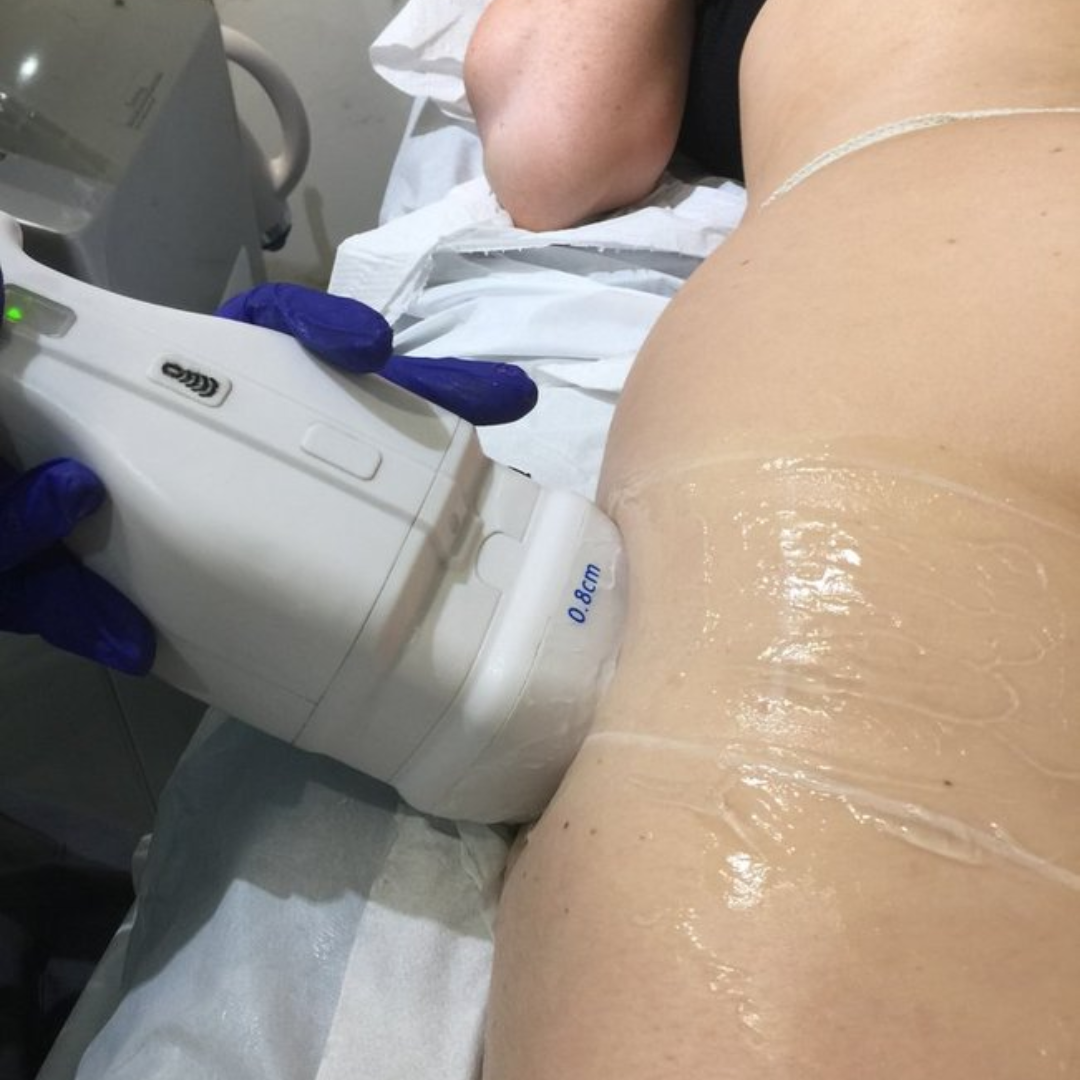 HIFU body treatment applicator in use at our Knightsbridge clinic near Harrods