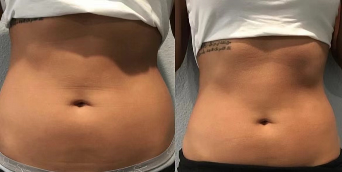 HIFU abdomen skin tightening before and after South Kensington