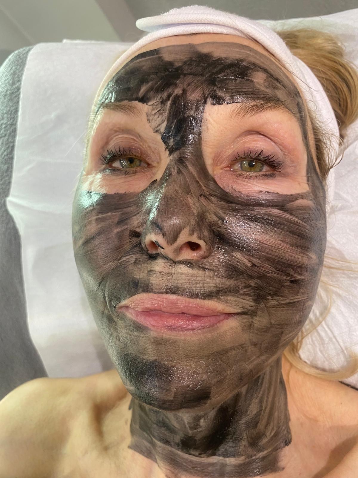 Carbon Laser Peel Treatment Mask Application in Chelsea