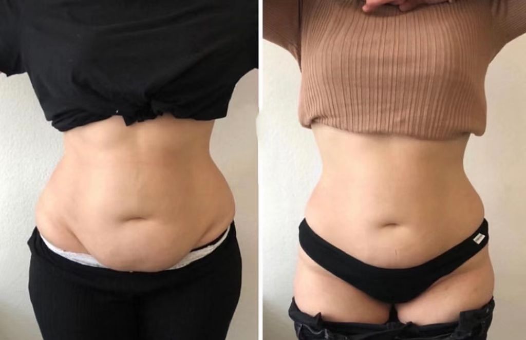 HIFU body sculpting before and after Belgravia London