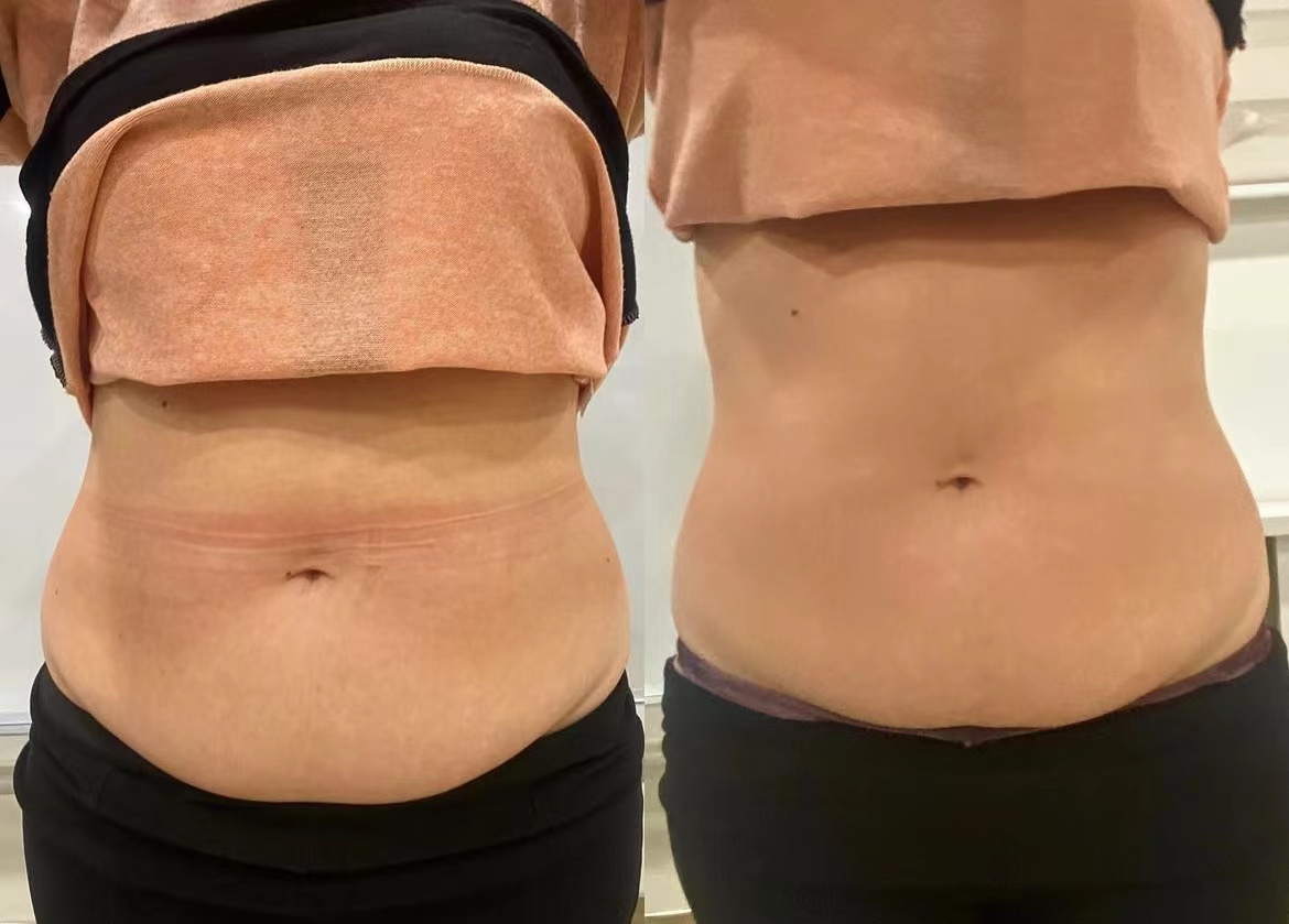 Non-surgical stomach tightening before and after results Knightsbridge