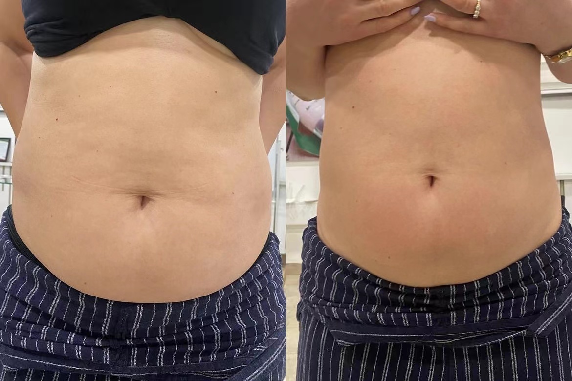 HIFU body contouring before and after stomach tightening Chelsea
