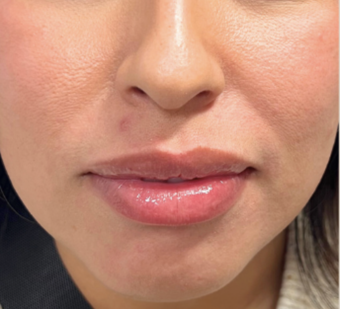 Dermal Fillers