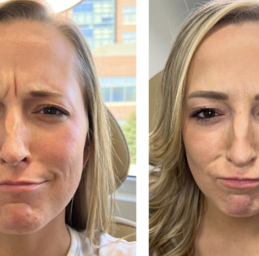 Botox & Wrinkle Relaxers