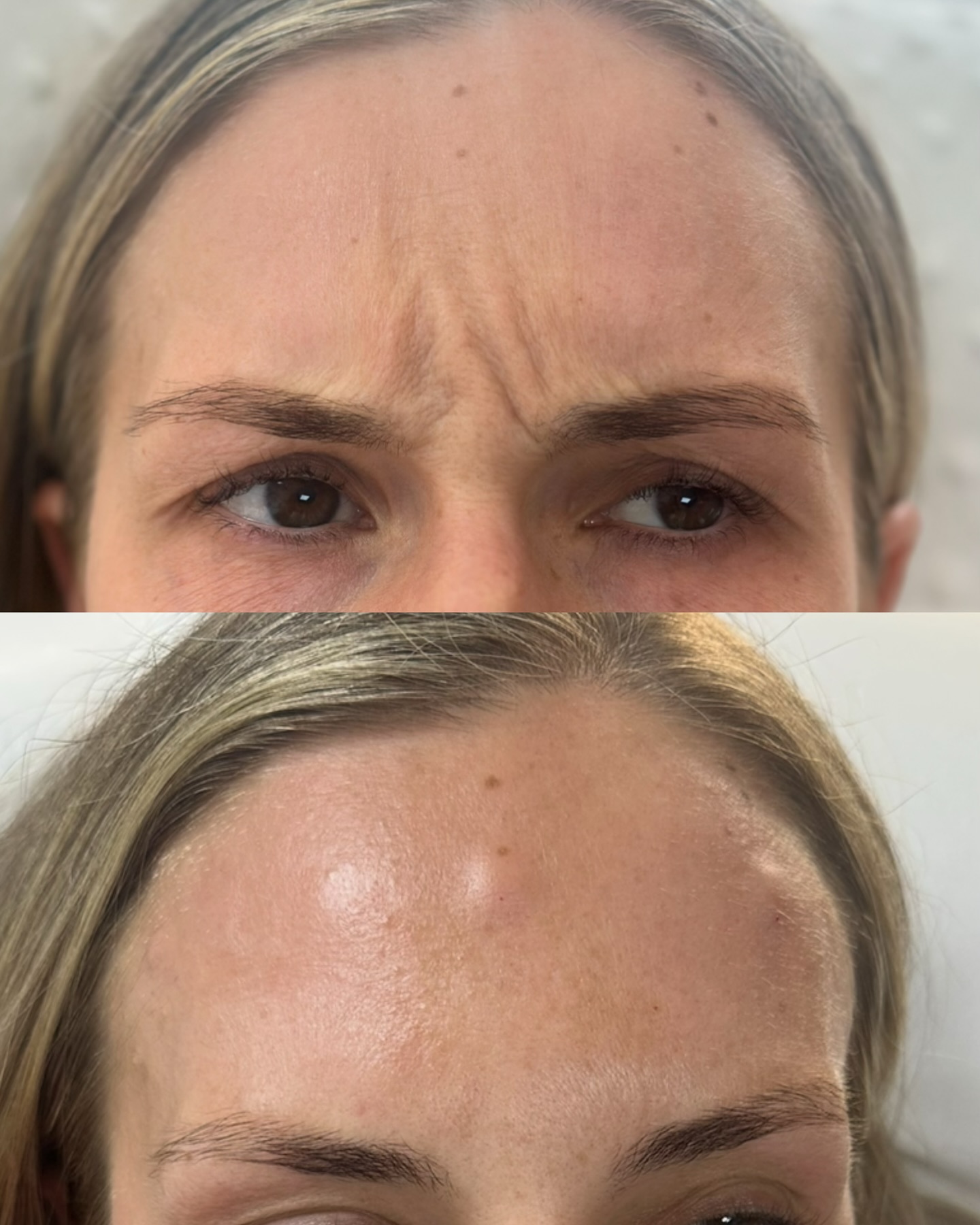 Anti-wrinkle injections