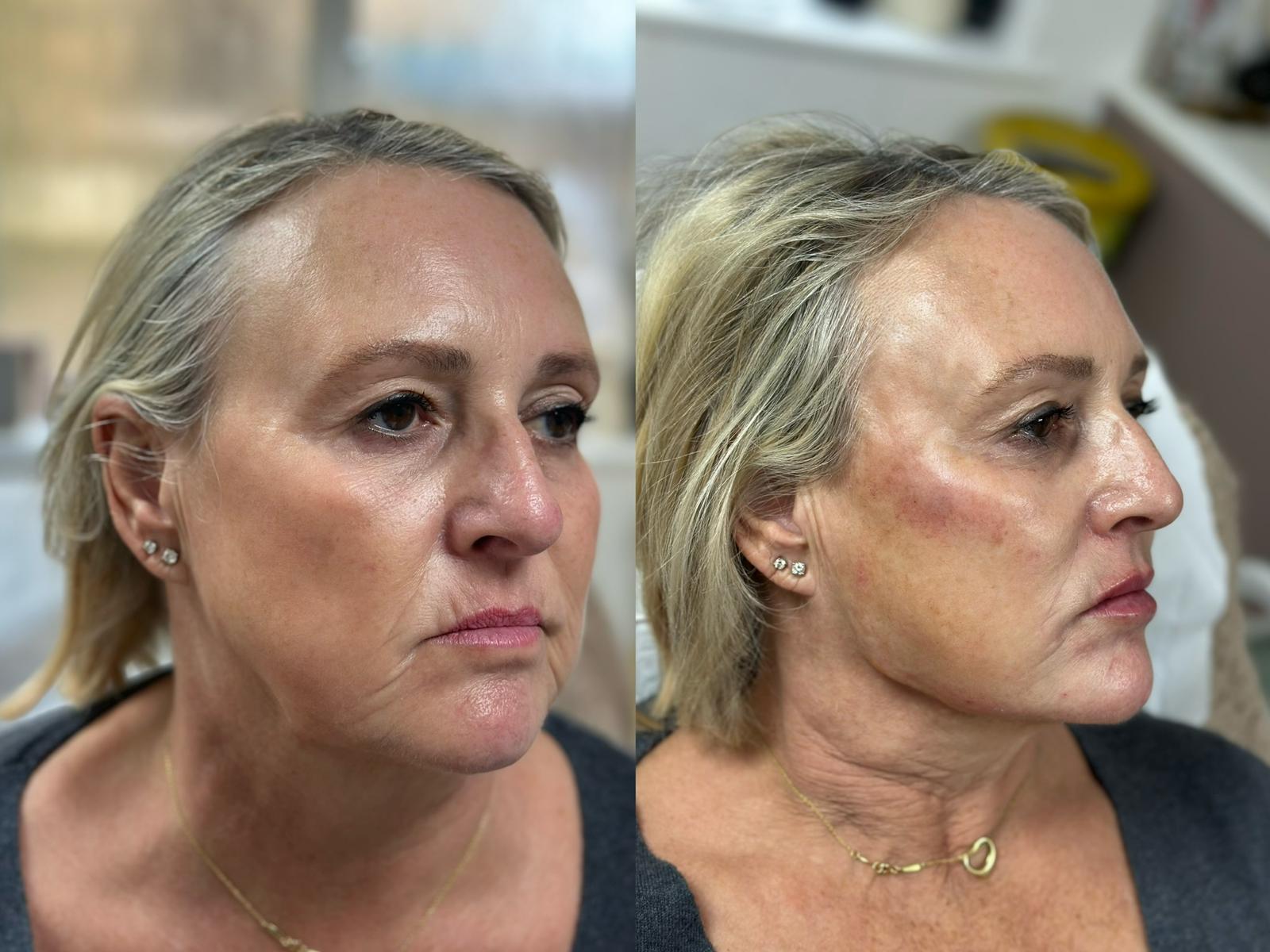 Dermal fillers