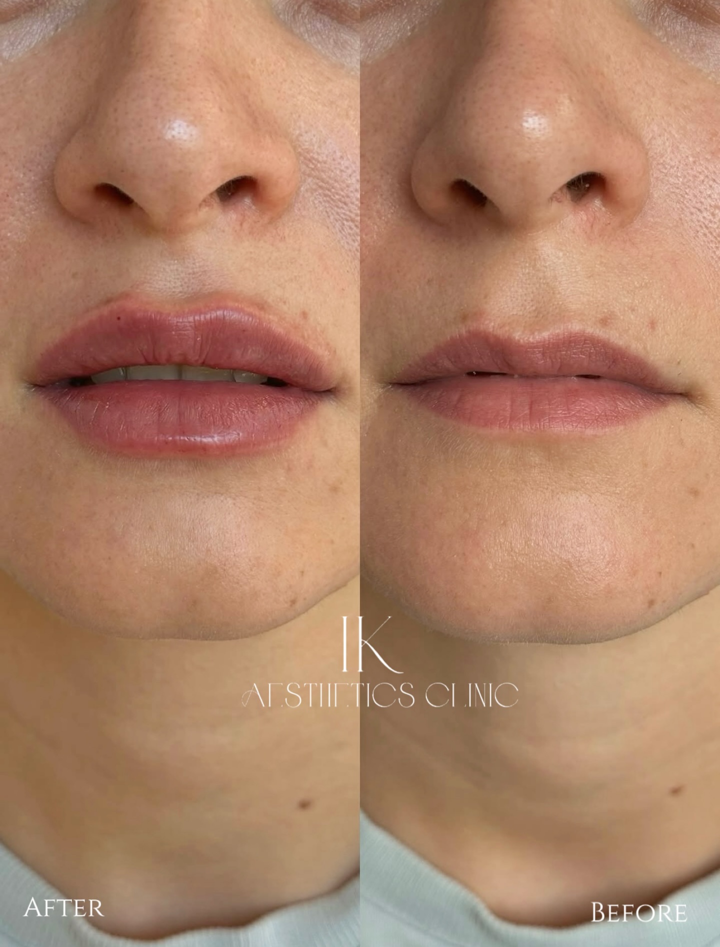 Lip fillers