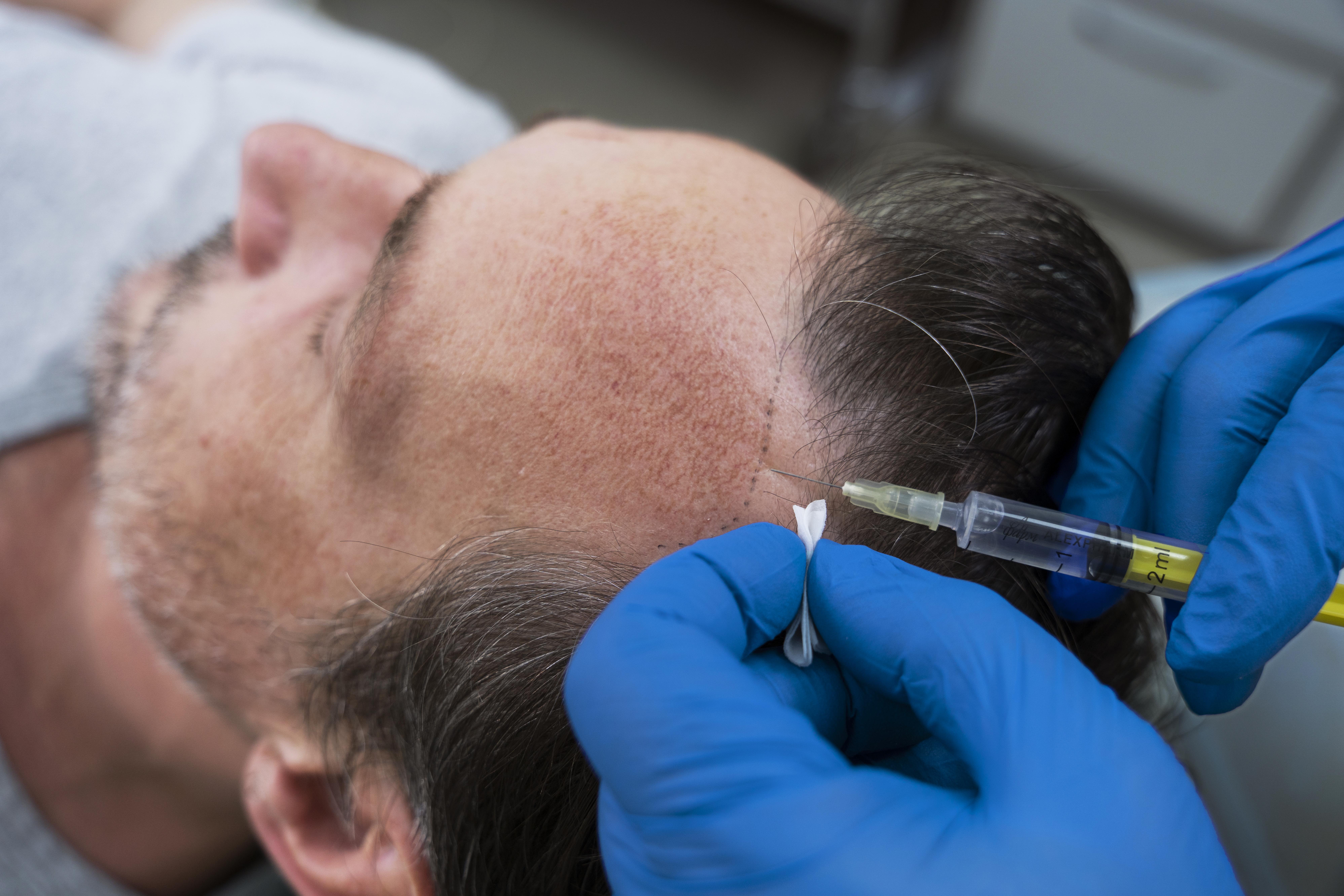 Hair Restoration