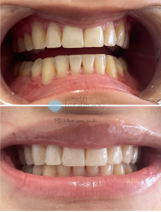 Before and after teeth whitening results