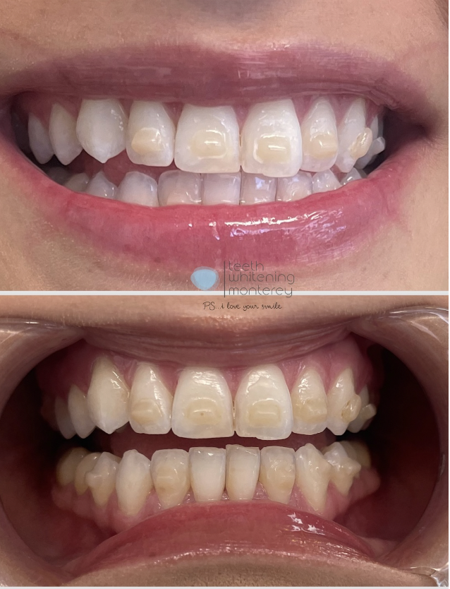 More before and after teeth whitening results