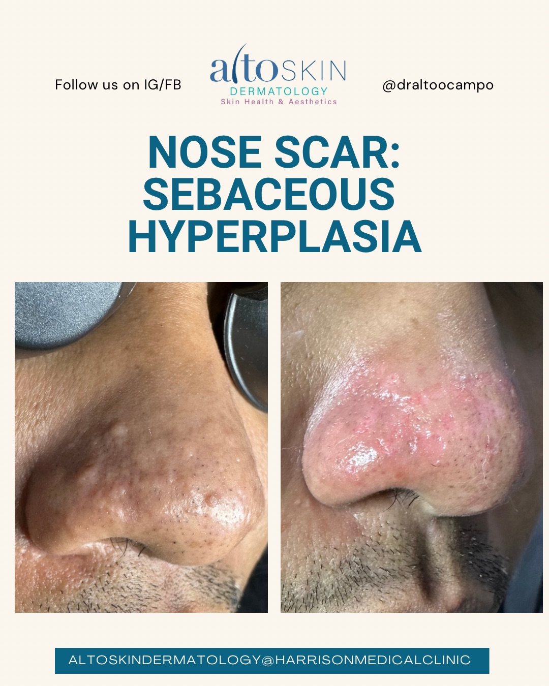 Sebaceous Hyperplasia