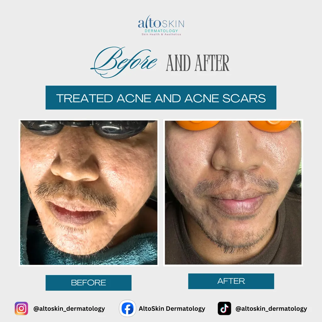 Treated Acne & Scars