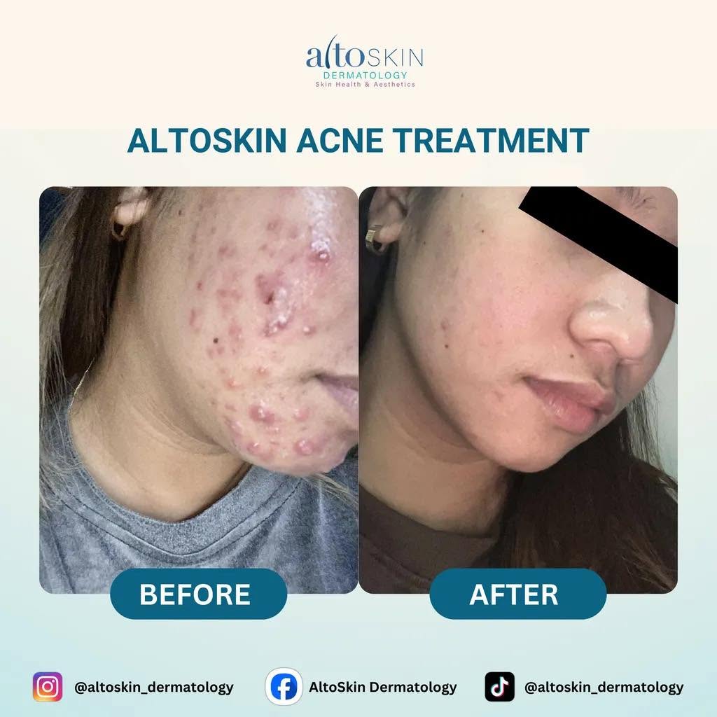 Acne Treatment
