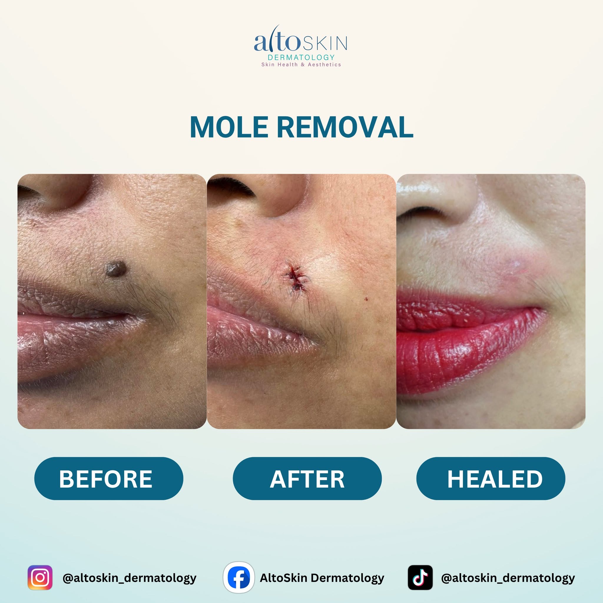 Mole Removal
