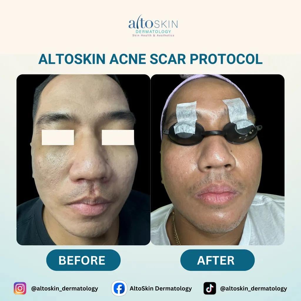 Acne Scar Protocol