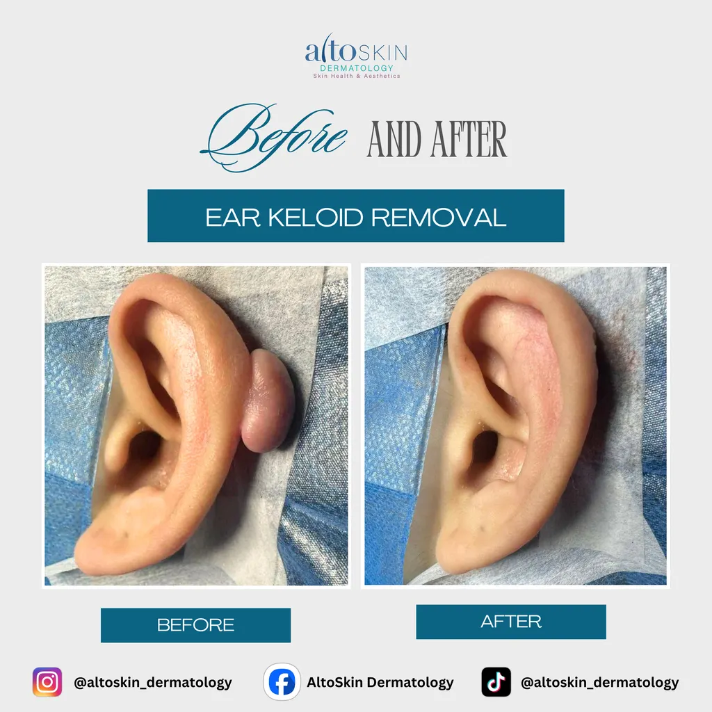 Ear Keloid Removal