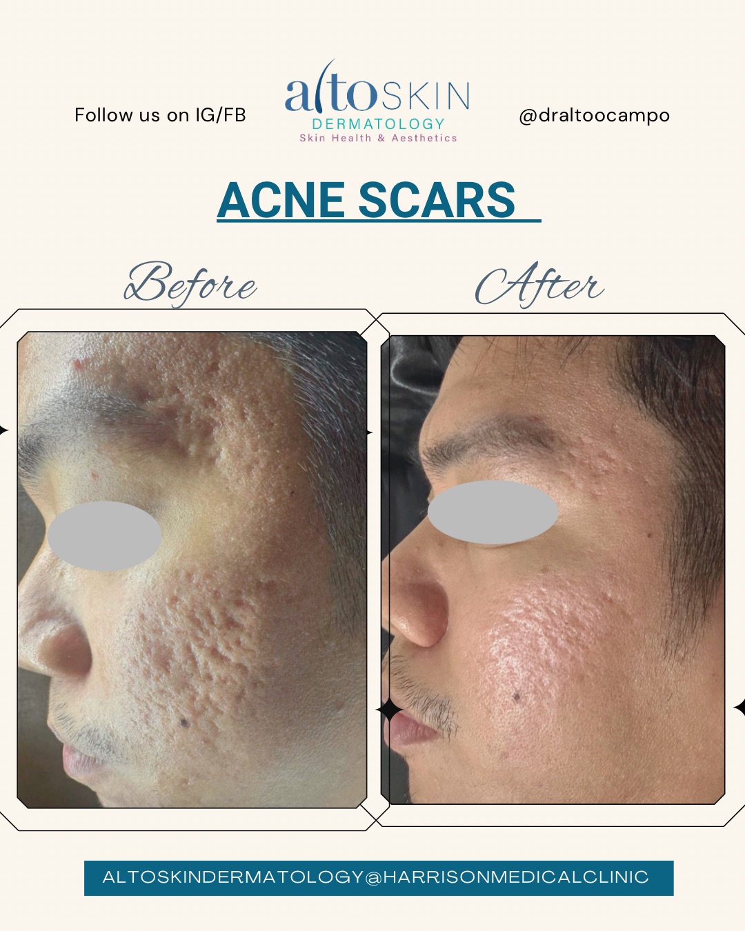 Acne Scars