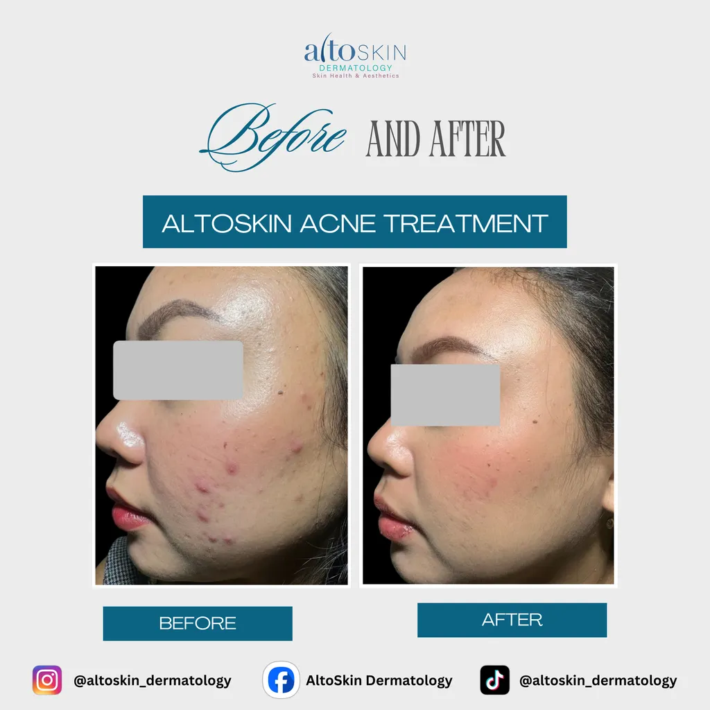 Acne Treatment