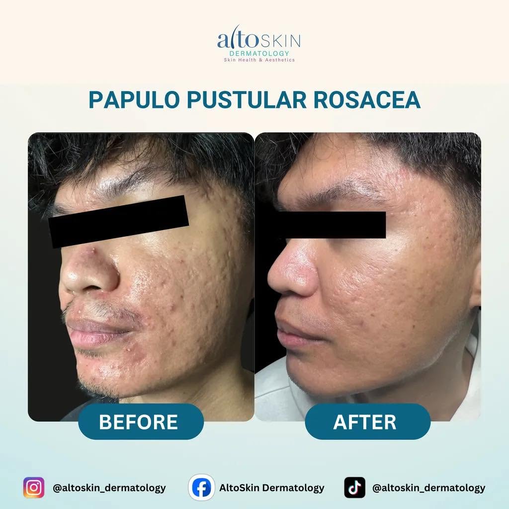 Papulo Pustular Rosacea