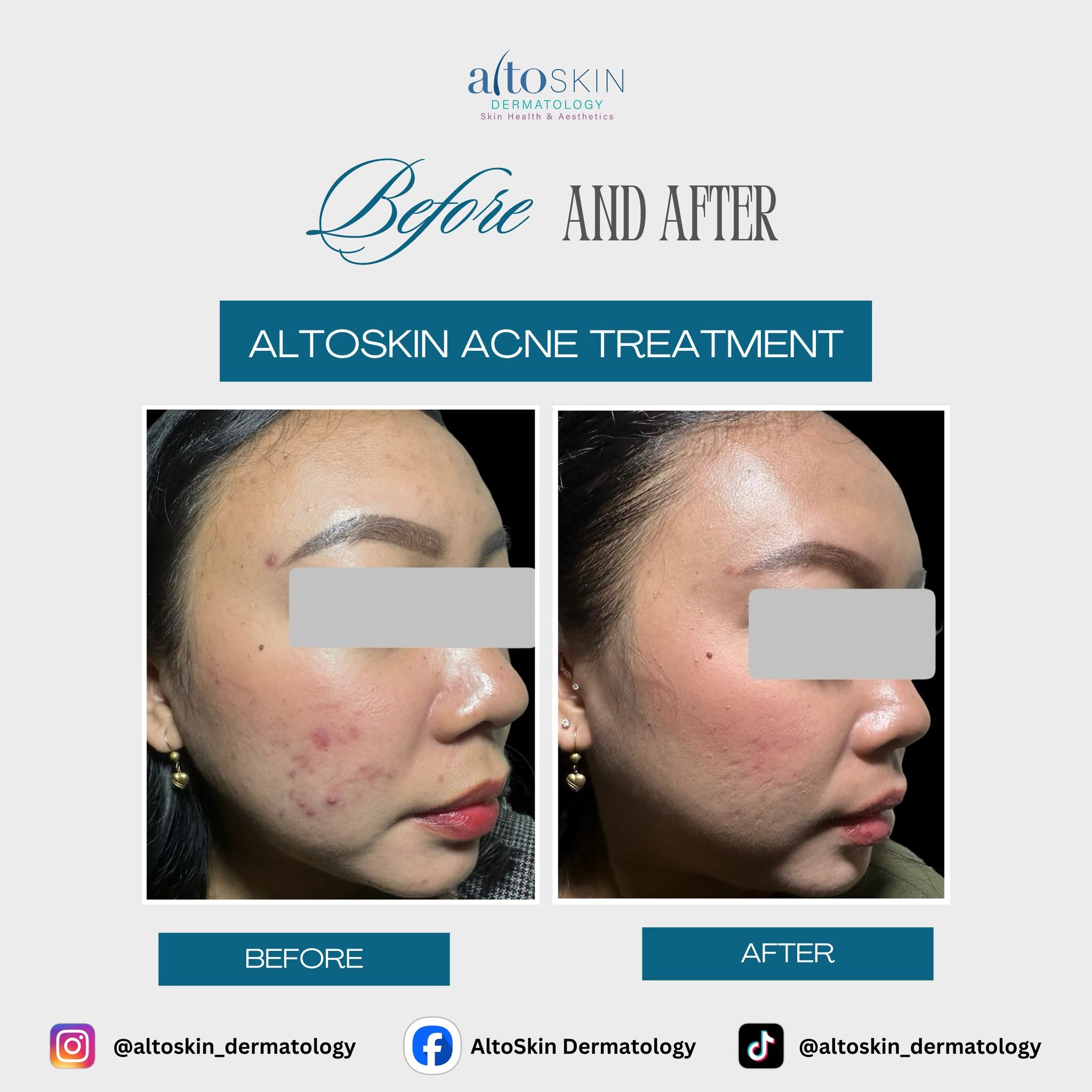 Acne Treatment