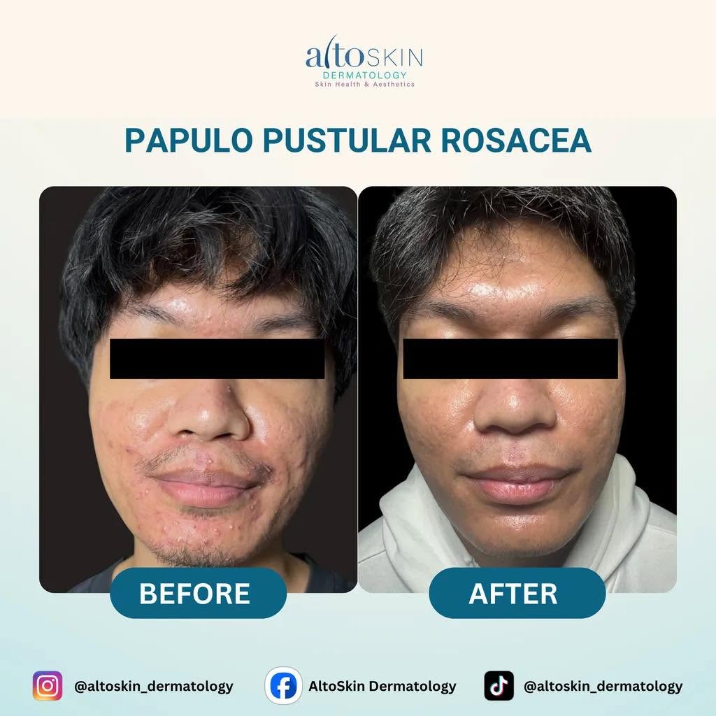 Papulo Pustular Rosacea