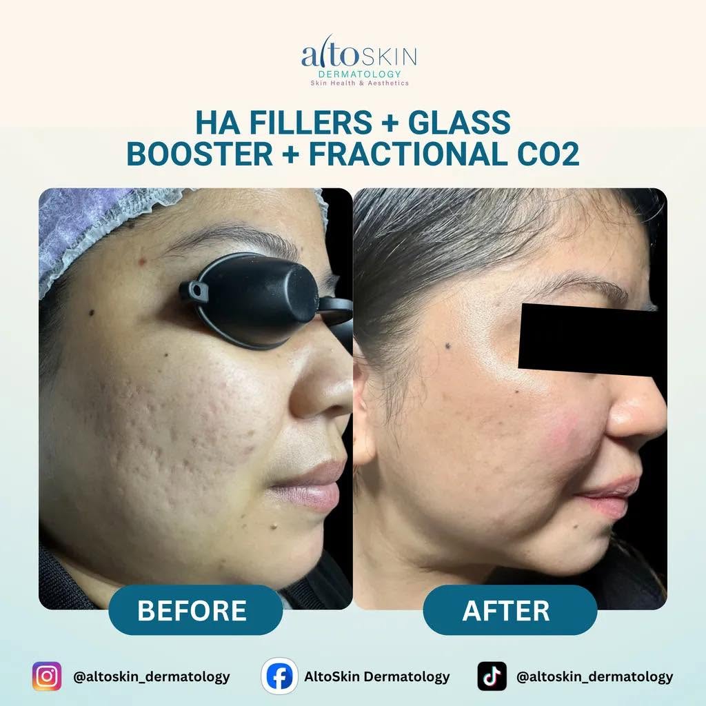 HA Fillers + Glass Booster + CO2
