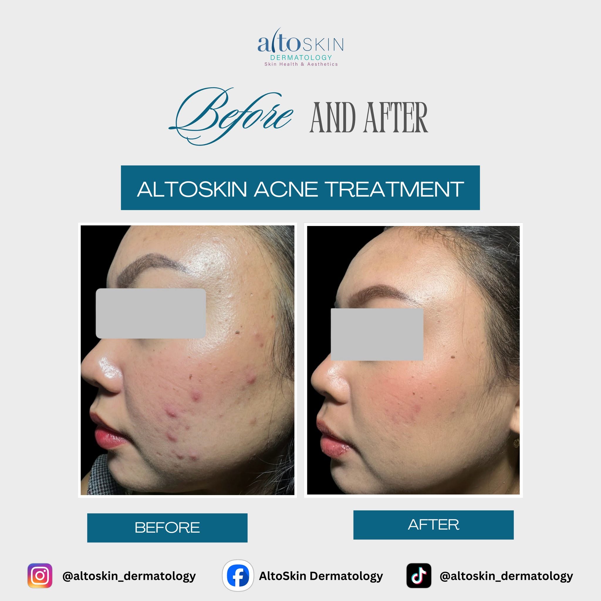 Acne Treatment