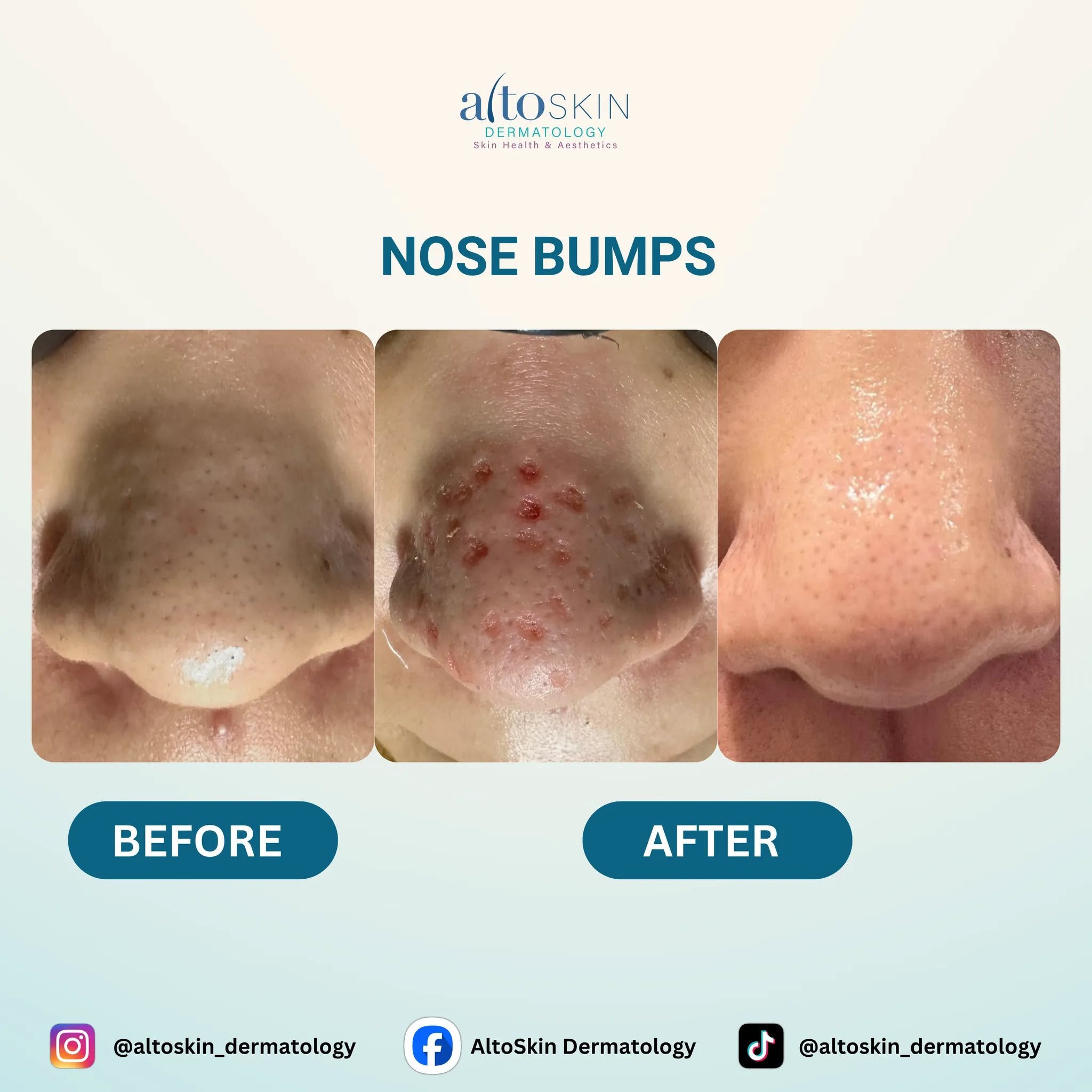 Nose Bumps