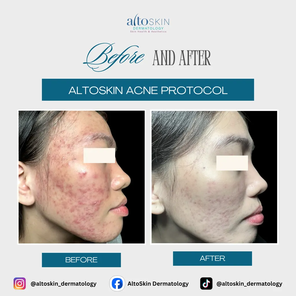 Acne Protocol