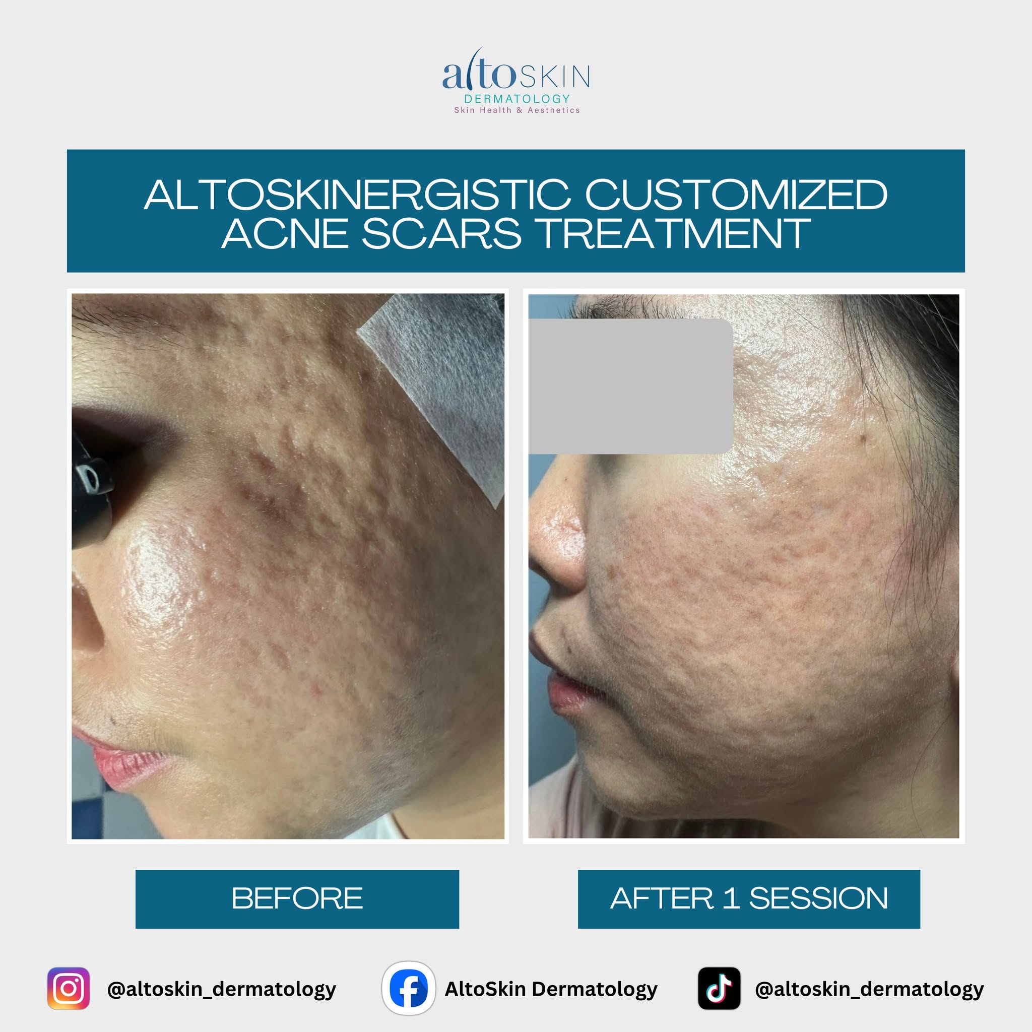 Customized Acne Scars