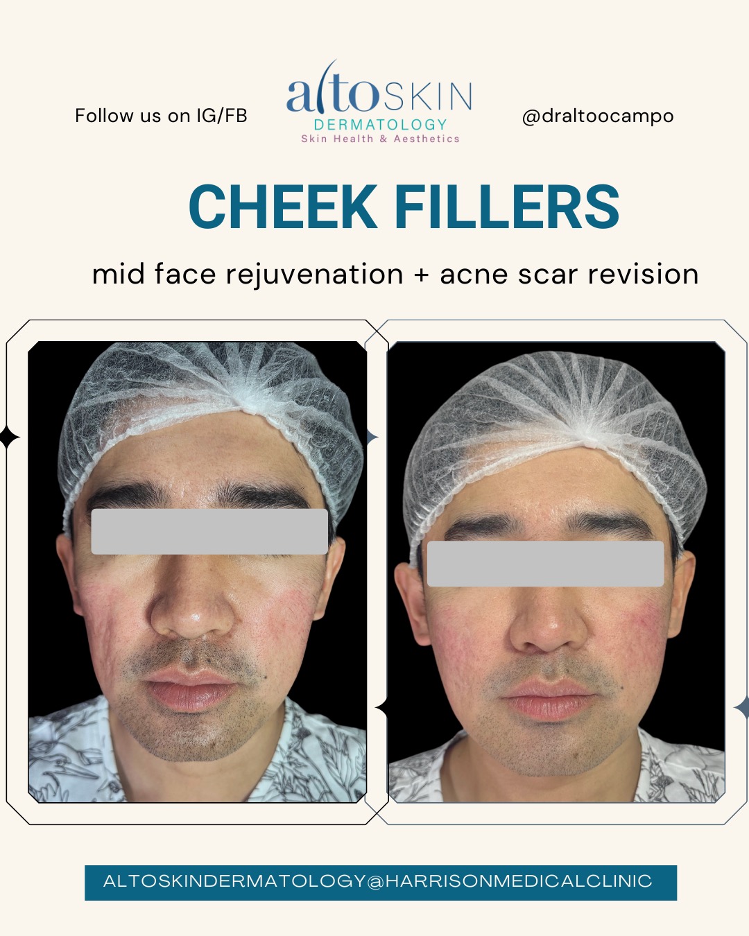 Cheek Fillers