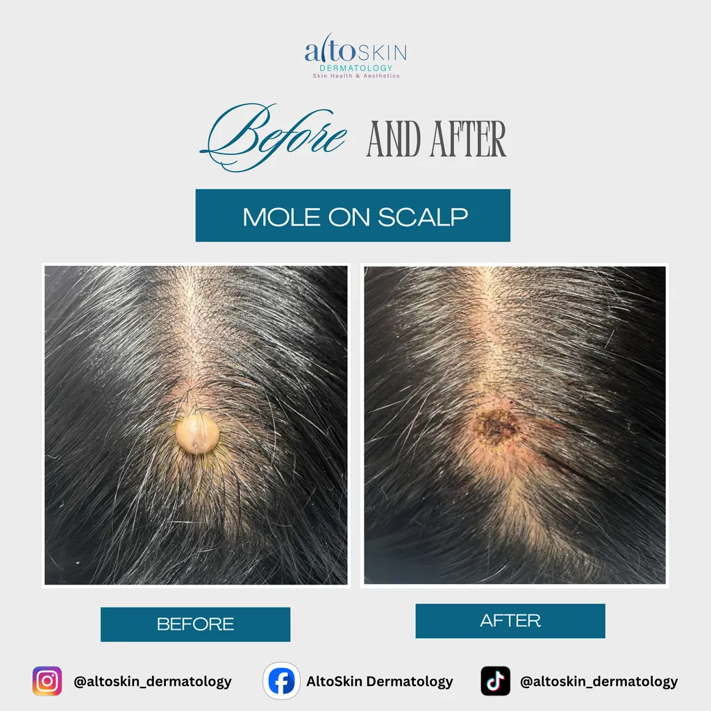 Mole on Scalp