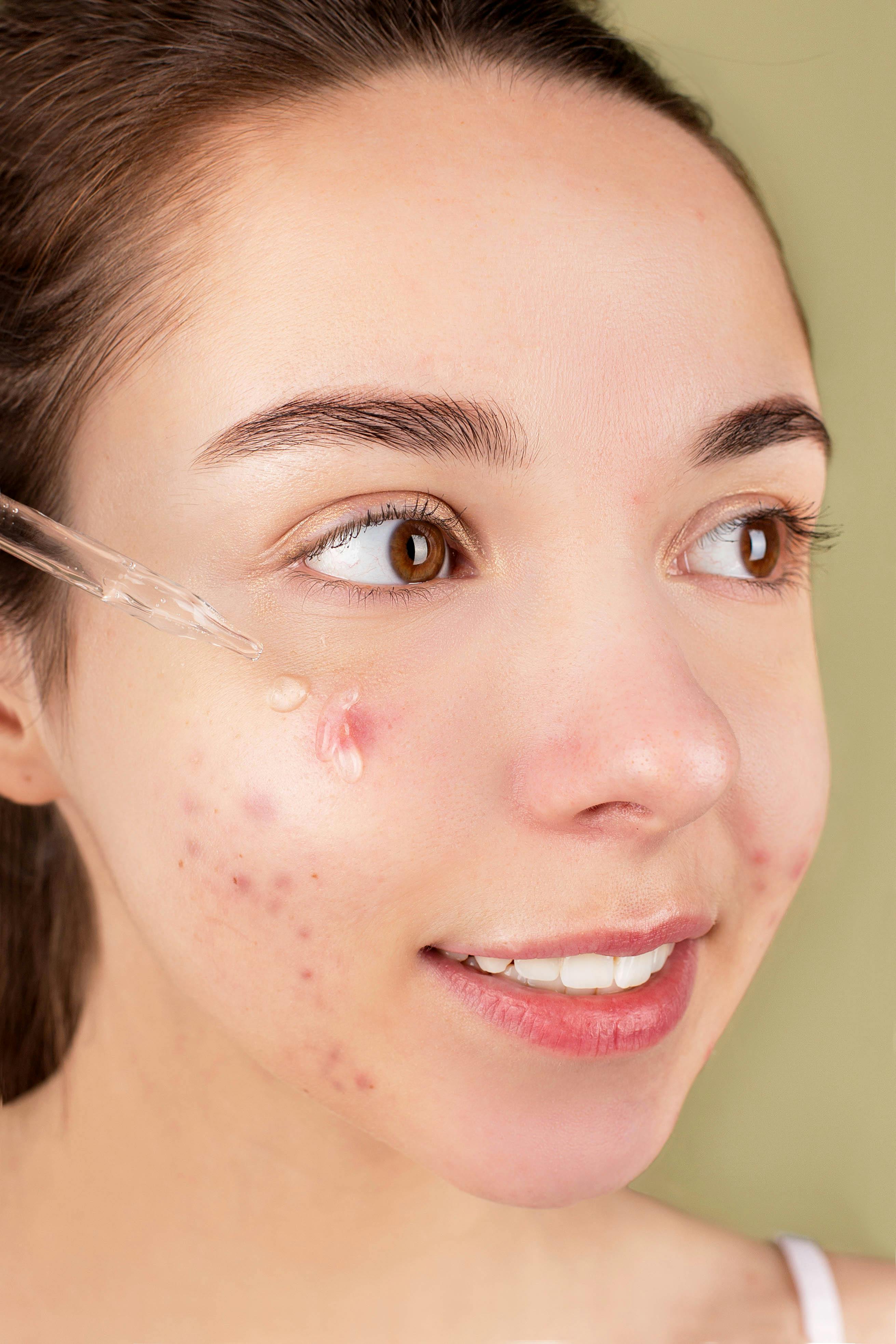 Acne Care
